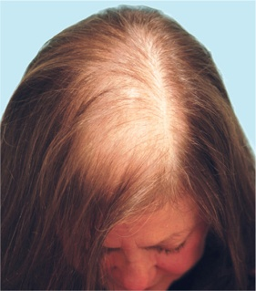 Female Pattern Hair Loss